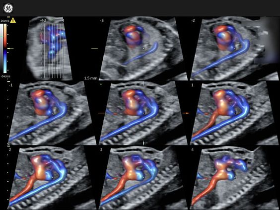 GE Voluson Expert 22 аппарат УЗИ