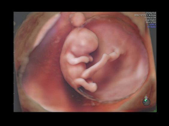 GE Voluson E10 аппарат УЗИ