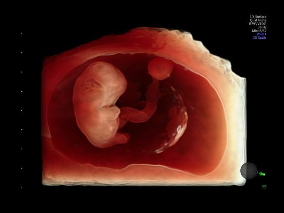 GE Voluson E10 аппарат УЗИ