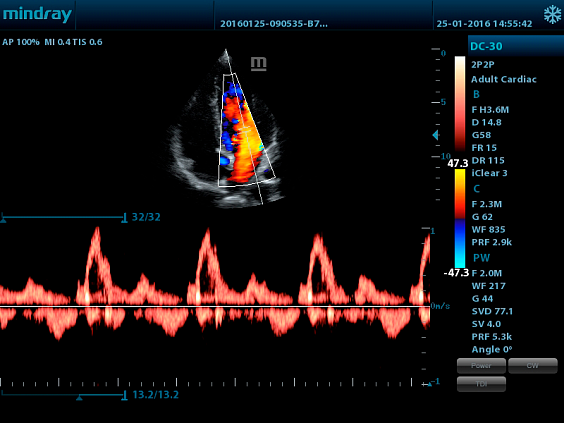 Mindray DC-30 аппарат УЗИ