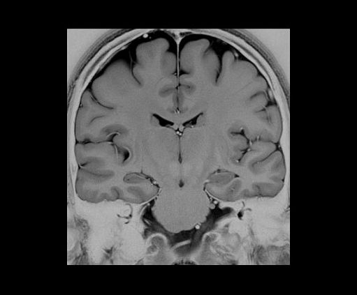 Магнитно-резонансный томограф GE SIGNA Architect 3T