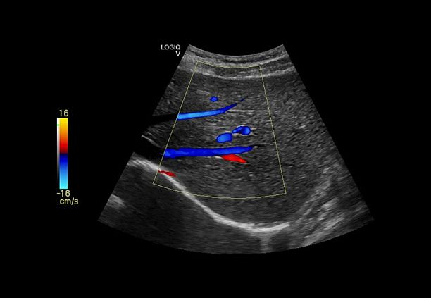 GE Logiq V2 УЗИ аппарат портативный