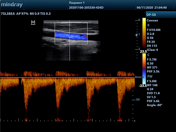 Mindray DP-50 Color аппарат УЗИ