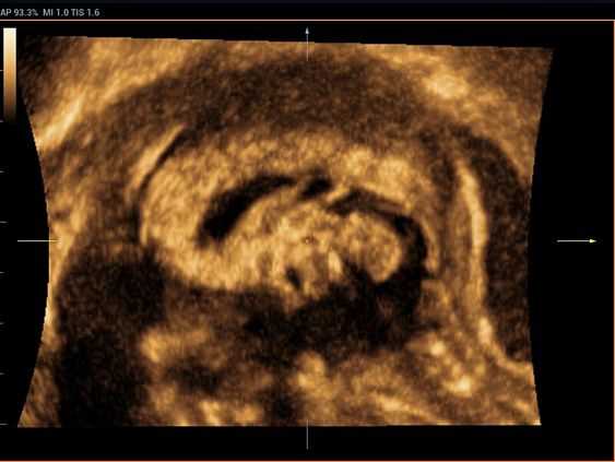 Mindray Resona 6 аппарат УЗИ 