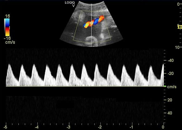 GE Logiq V5 аппарат ультразвуковой