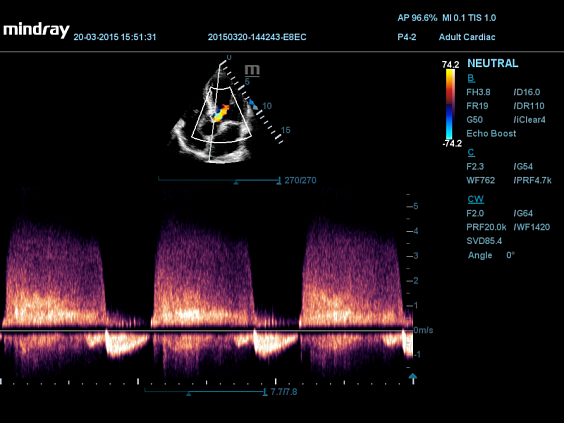УЗИ аппарат Mindray DC-55