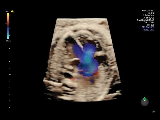 GE Voluson E10 аппарат УЗИ