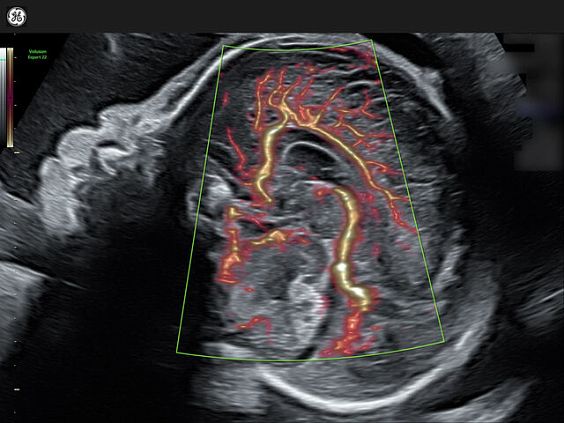 GE Voluson Expert 22 аппарат УЗИ