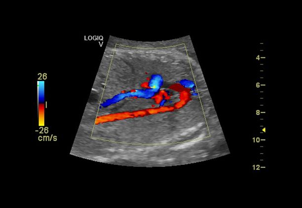 GE Logiq V2 УЗИ аппарат портативный