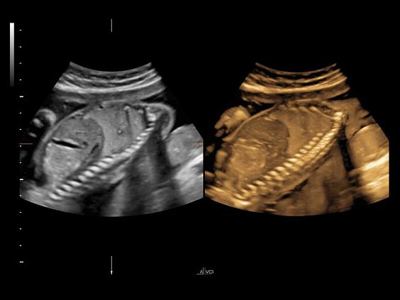 GE Voluson E10 аппарат УЗИ