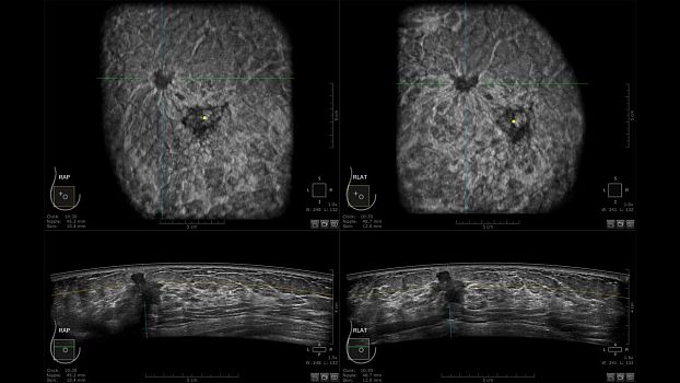GE Invenia ABUS ультразвуковая система