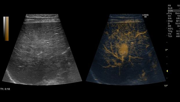 GE Logiq S8 XDclear ультразвуковая диагностическая система