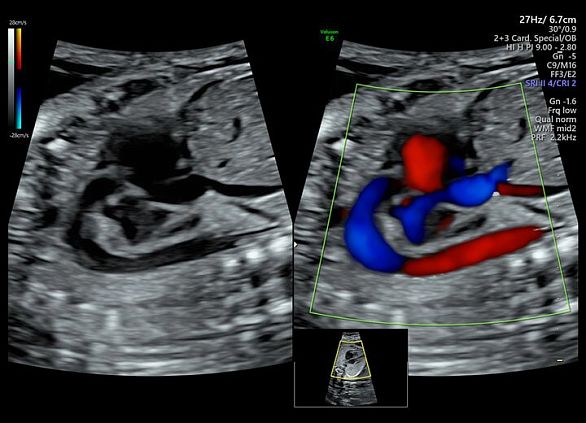 GE Voluson E6 аппарат УЗИ