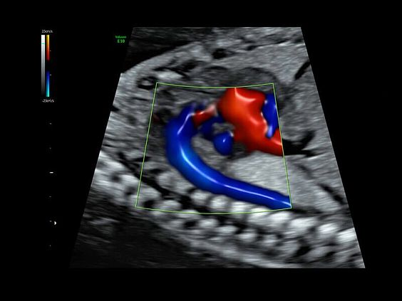 GE Voluson E10 аппарат УЗИ