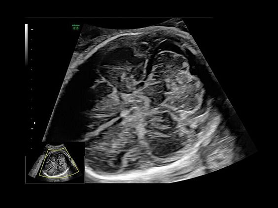 GE Voluson E10 аппарат УЗИ