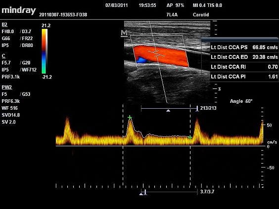 Mindray DC-N6 ультразвуковой аппарат