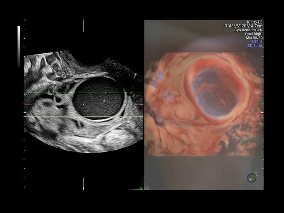 GE Voluson E10 аппарат УЗИ