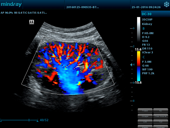 Mindray DC-30 аппарат УЗИ