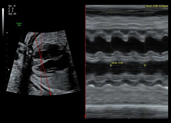 GE Voluson E6 аппарат УЗИ