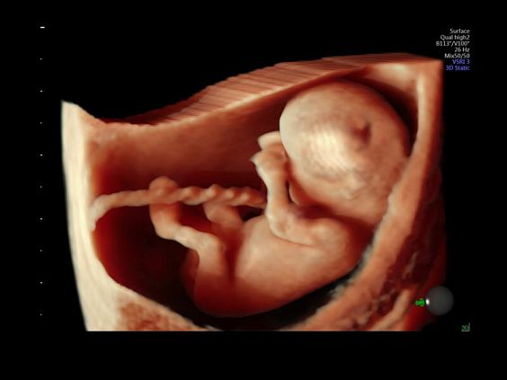 GE Voluson E10 аппарат УЗИ