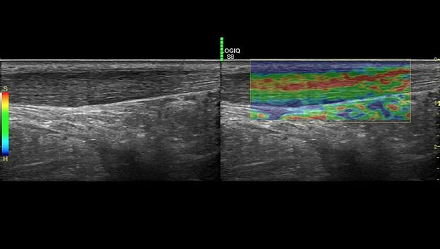 GE Logiq S8 XDclear ультразвуковая диагностическая система