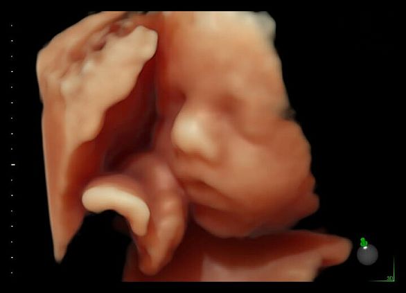 GE Voluson E6 аппарат УЗИ